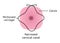 McDonald cerclage tightening of cervix opening during pregnancy. Anatomy of cervical canal. cervix weakness and black