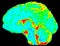 Mean Diffusivity Brain Map in Sagittal View