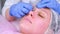 Mechanical cleaning of the face at the beautician. Cosmetologist pierces the acne on the face of the patient medical