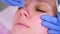 Mechanical cleaning of the face at the beautician. Cosmetologist squeeze the acne on the nose of the patient medical