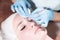 Mechanical face peel at the beautician. Beautician squeezes acne on the patient`s forehead with a medical needle. Face