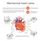 Mechanical heart valve. Vector, Illustration Design.