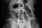 mechanical small bowel obstruction