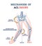 Mechanism of ACL injury as knee trauma anatomical explanation outline diagram