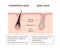 Mechanism of pigmented hair and gray hair / comparison vector illustration