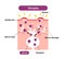 Mechanism of shingles ( herpes zoster ) vector illustration