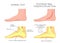 Medial ankle injury_Posterior tibial tendon dysfunction