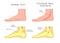 Medial ankle injury_Posterior tibial tendonitis