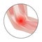 Medial epicondylitis golfer elbow