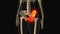 Medical animation of the hip bone pain