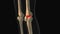 Medical animation of the knee pain