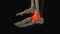 Medical animation of the talus bone pain