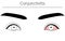 Medical Clipart, Line Drawing Illustration of Eye Disease and Conjunctivitis
