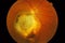 Medical Fundus photo of retinal patology