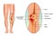 Medical illustration of bone edema on knee