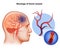 Medical illustration of Human Brain arteries blockage