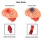 Medical illustration of Human Brain  arteries  blockage