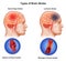 Medical illustration of Human Two Types of Brain Stroke