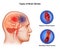 Medical illustration of Human Two Types of Brain Stroke