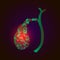 Medical illustration of intestinal diseases, stones in the gallbladder. Cholelithiasis. cholecystitis. Dyskinesia of the biliary t