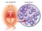 Medical illustration of oral candidiasis