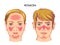 Medical illustration of Rosacea on face