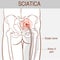 Medical illustration of symptoms of sciatica