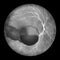 A medical illustration of Terson syndrome, revealing intraocular hemorrhage observed during ophthalmoscopy