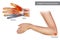 Medical illustration to explain Cubital tunnel syndrome. Ulnar nerve entrapment. Fascia involved in ulnar nerve