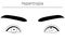 Medical illustrations, diagrammatic line drawings of eye diseases, strabismus and hypertropia