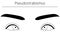 Medical illustrations, diagrammatic line drawings of eye diseases, strabismus and pseudostrabismus