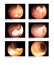 Medical image Gastrointestinal endoscopic examination image Finding polyp upper rectum and sigmoid with post polypectomy Image