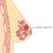 Medical Infographic Cross Section of Female Breast with Abscess. Information card with pus filled lump. Anatomy of Woman