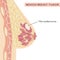 Medical Infographic Cross Section of Female Breast with Fibroadenoma. Information card with benign breast lesion