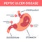 Medical infographics with types of peptic ulcer stomach disease