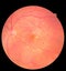 Medical photo retina diabetic retinopathy. Examination of the eye, diabetic retinopathy, ARMD