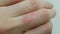 Medical review of the patient`s hand by a dermatologist: dry eczema crust on the hand. Allergic lesions of the skin