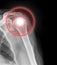 Medical science for shoulder treatment