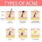 Medical vector illustration of different types of acne on human skin. Appearance of pimples in hair follicle