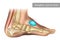 Medical vector illustration of ganglion foot cyst with bones. Big ganglion cysts,a sac of jelly like fluid,is on the