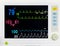 Medical vital sign monitor screen in operating room or hospital.Heart rate or blood pressure was recorded.