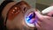 Medicine, dentistry and healthcare concept. Close-up partial view of dentist using dental curing UV lamp