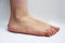 Medicine, flat feet, tarsoptosia, foot female isolated