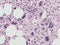 Megakaryocytic hyperplasia in primary myelofibrosis
