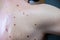 Melanocytic nevus, some of them dyplastic or atypical, on a caucasian man of 36 years old