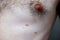 Melanocytic nevus, some of them dyplastic or atypical, on a caucasian man of 36 years old