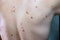 Melanocytic nevus, some of them dyplastic or atypical, on a caucasian man of 36 years old