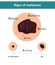 Melanoma ABCDE signs. Vector illustration of skin patch with skin cancer