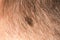 Melanoma angioma beauty mark