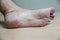 Men`s feet with cracked, unkempt skin after paresis of the lower extremities.